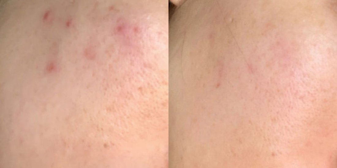 Skin before and after using the Filtered Showerhead